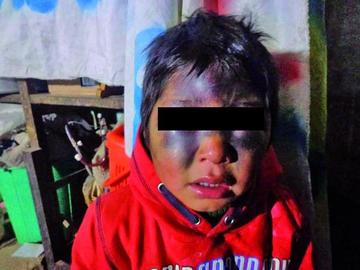 Padrastro desfigura rostro de un niño y está en terapia intensiva