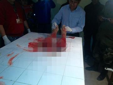 El médico forense en la autopsia legal al cadáver.