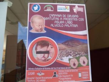 Campaña: las cirugías de labio leporino serán gratis