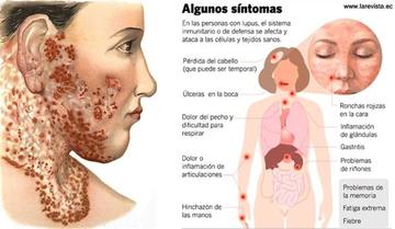 Santa Cruz: 200 pacientes tienen enfermedad de lupus