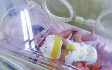 Fallece por un paro cardíaco la bebé que nació con el corazón expuesto