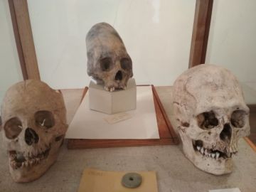 Cráneo trepanado.