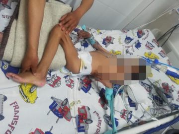 Internan en terapia pediátrica a niño con desnutrición aguda