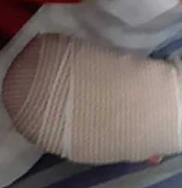 Niño de 3 años pierde parte del antebrazo al meter a un molino de carne