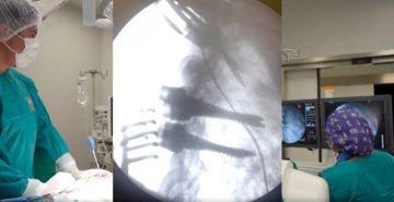 Realizan cirugía a paciente con destrucción vertebral en hospital Natalini