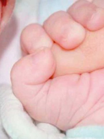 Nace bebé hermafrodita en Guayaramerín