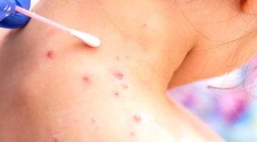 Mantienen alerta y reforzarán la vigilancia ante la viruela MPOX