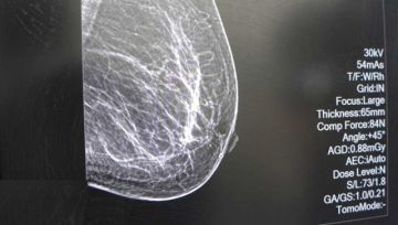 Campaña detectó tres pacientes con riesgo de cáncer de mama