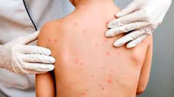 Sedes detecta dos nuevos casos positivos de sarampión en Potosí