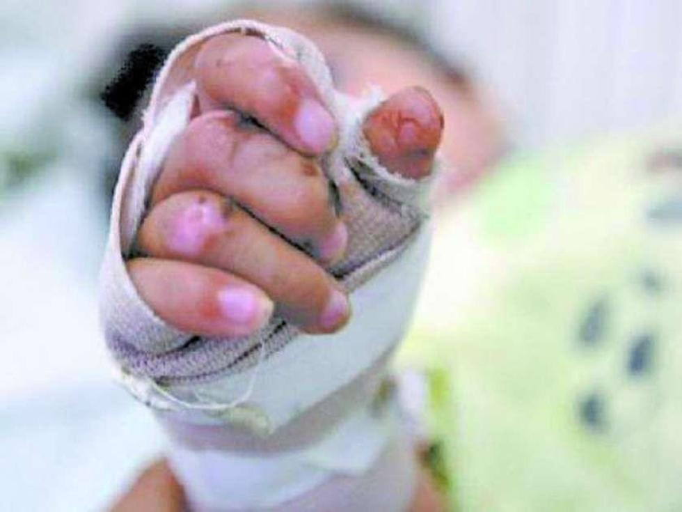 Defensoría continúa con el proceso de niño quemado