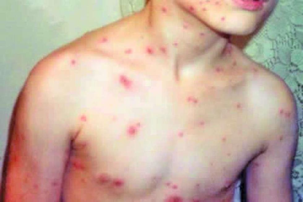 Detectan 13 casos de varicela infantil