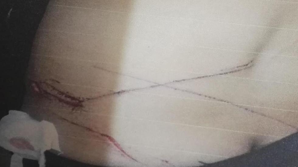 Ebrio agrede a su enamorada con un cuchillo marcándole con una "X"
