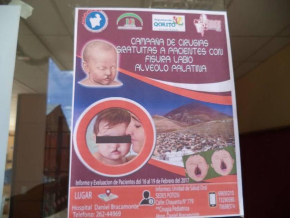 Campaña: las cirugías de labio leporino serán gratis