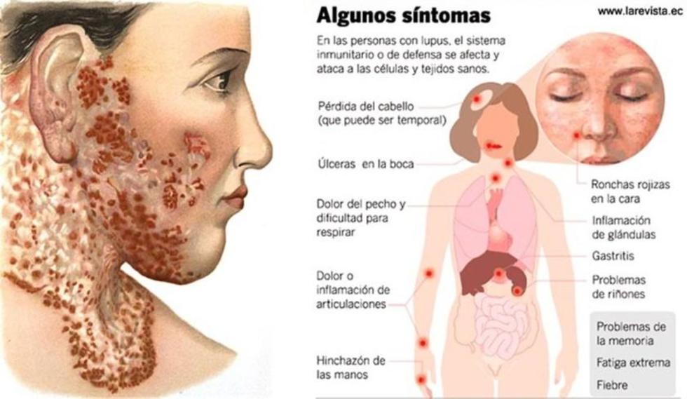 Santa Cruz: 200 pacientes tienen enfermedad de lupus
