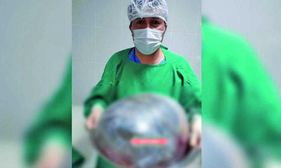 En Riberalta le extraen a una mujer un quiste ovárico de 25 kilos
