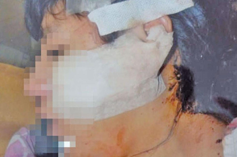Mujer recibe 50 puntos de sutura en el rostro