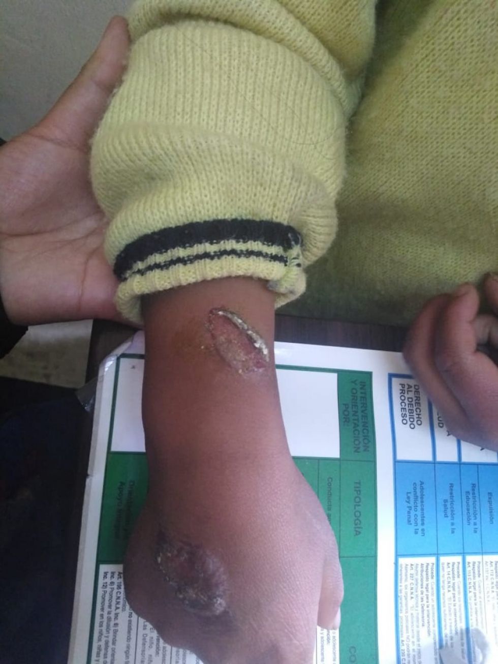 Padre incendia la mano de su hijo porque alzó dinero