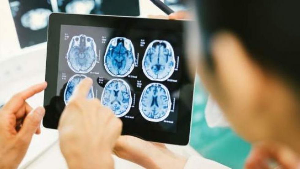 La COVID-19 grave puede causar complicaciones cerebrales, según un estudio