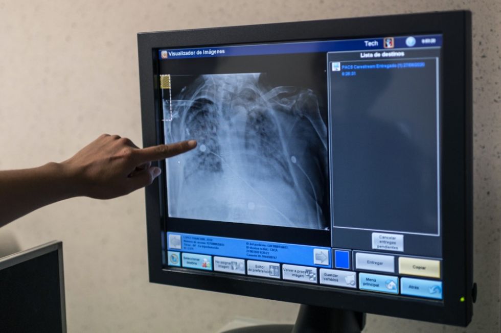 México realiza primer transplante bipulmonar poscovid-19