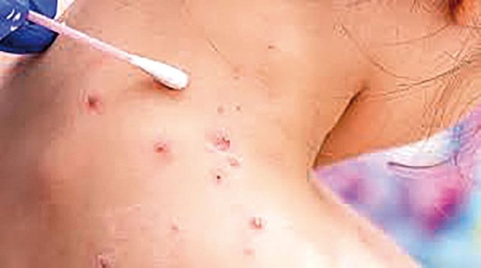 Viruela símica ya presente en cuatro departamentos