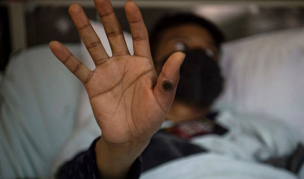 La OMS cifra más de 50.000 casos de viruela del mono en todo el mundo
