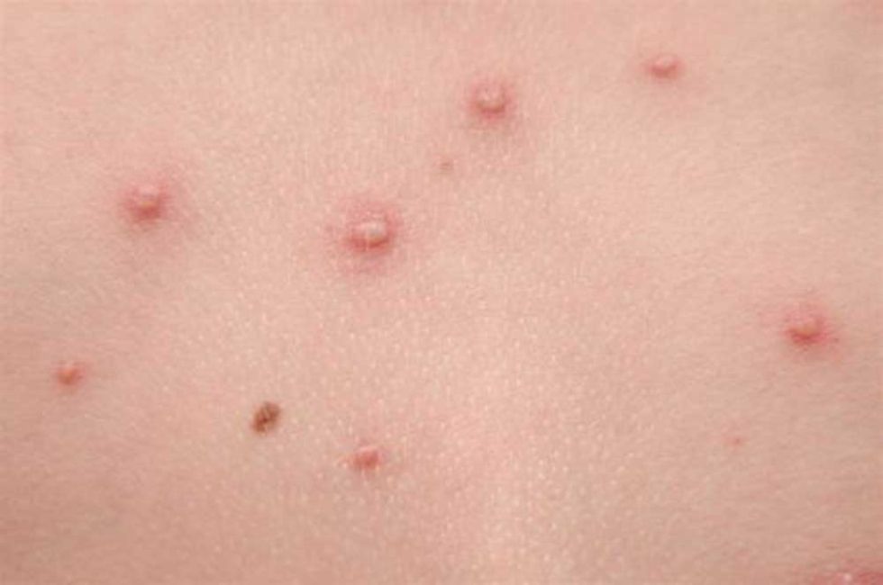 Cuatro pacientes con viruela del mono fueron dados de alta en el departamento de La Paz