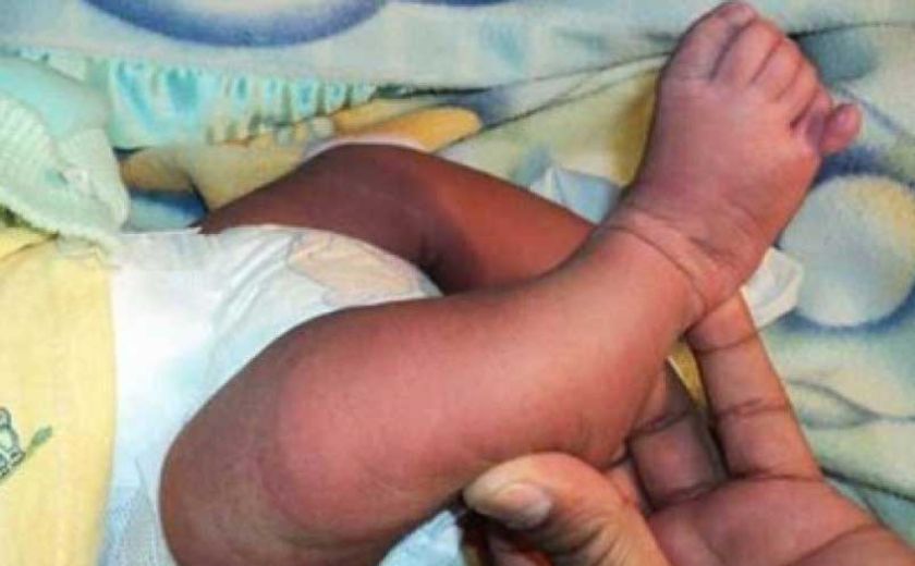 Develan nacimientos  de niños con defectos