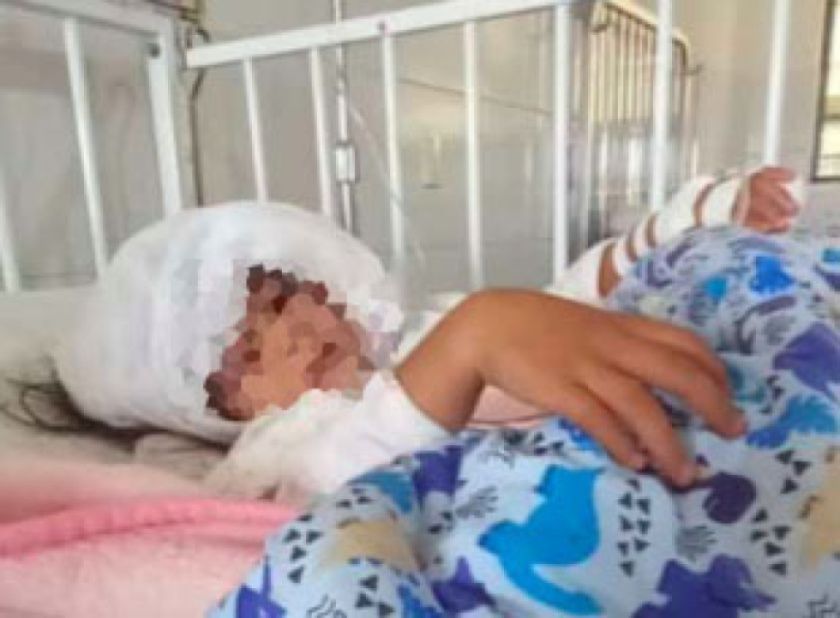 Familiares piden ayuda para niña que fue atacada por un perro en Chuquisaca