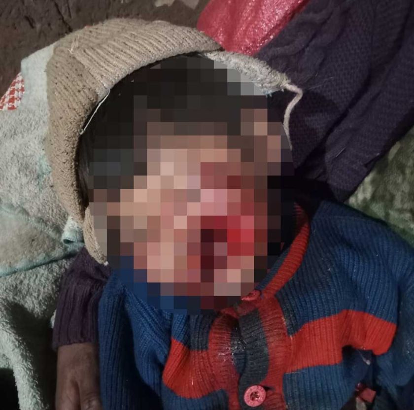 Perro ataca a un niño y le desfigura su cara