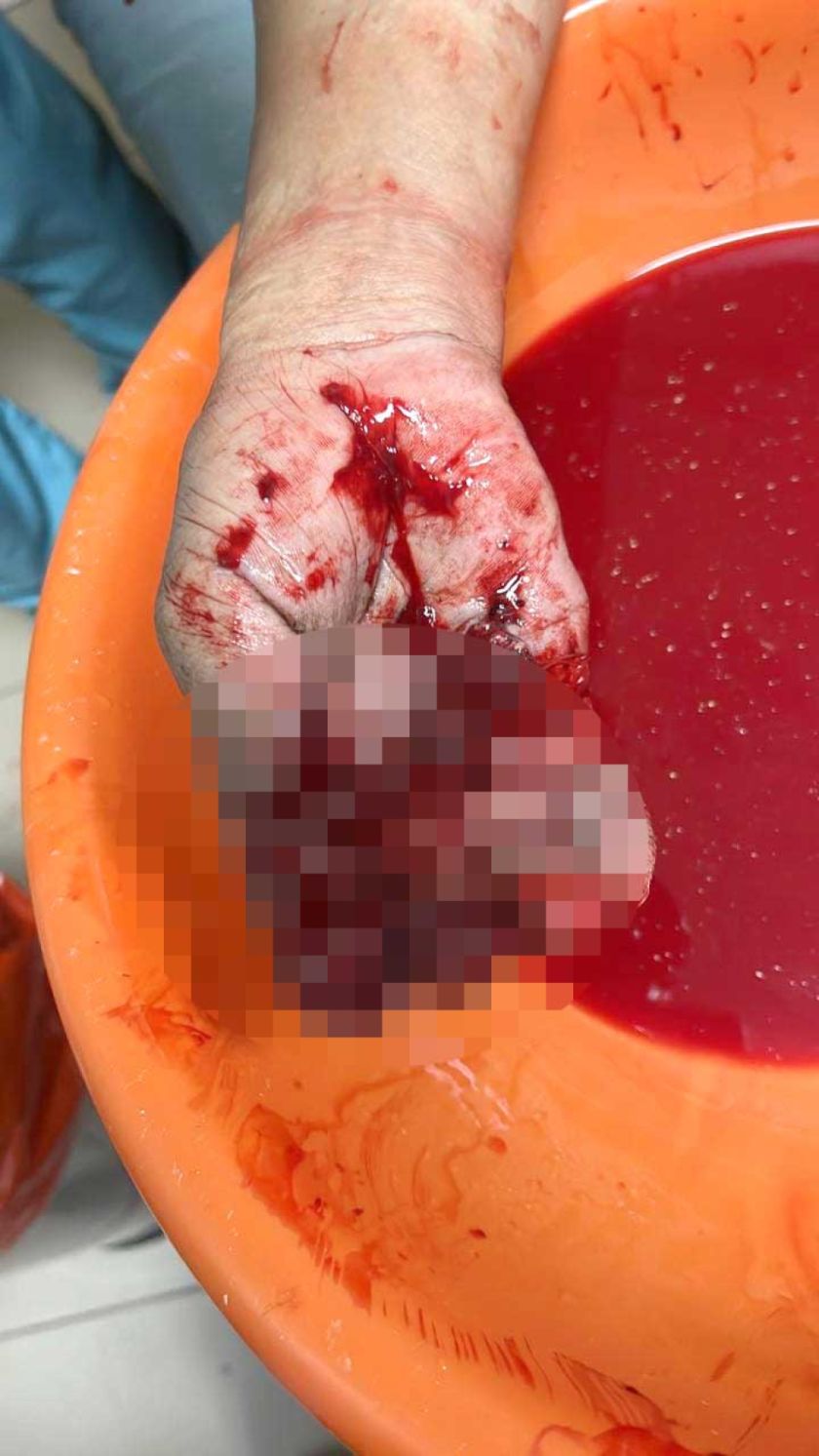 Un dirigente indígena de Potosí pierde tres dedos de la mano 