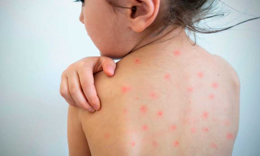 Piden a los padres hacer vacunar a sus hijos contra el sarampión 