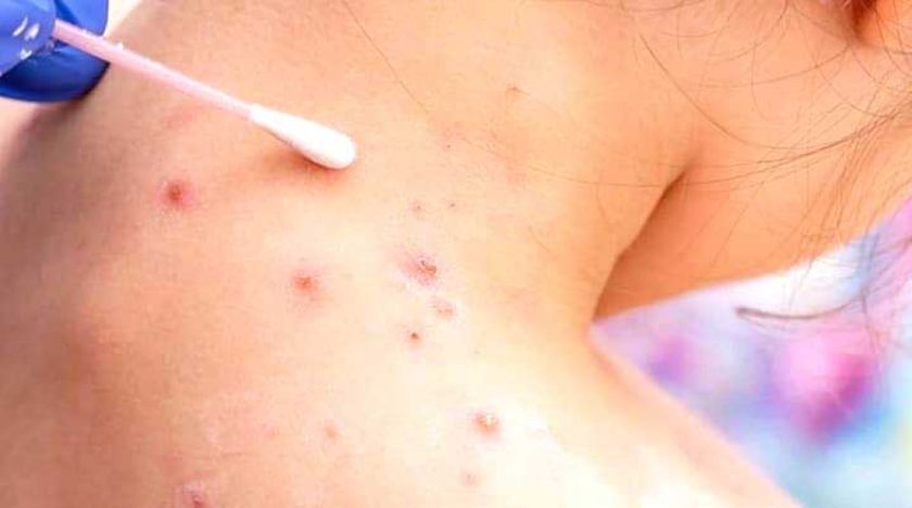 Mantienen alerta y reforzarán la vigilancia ante la viruela MPOX