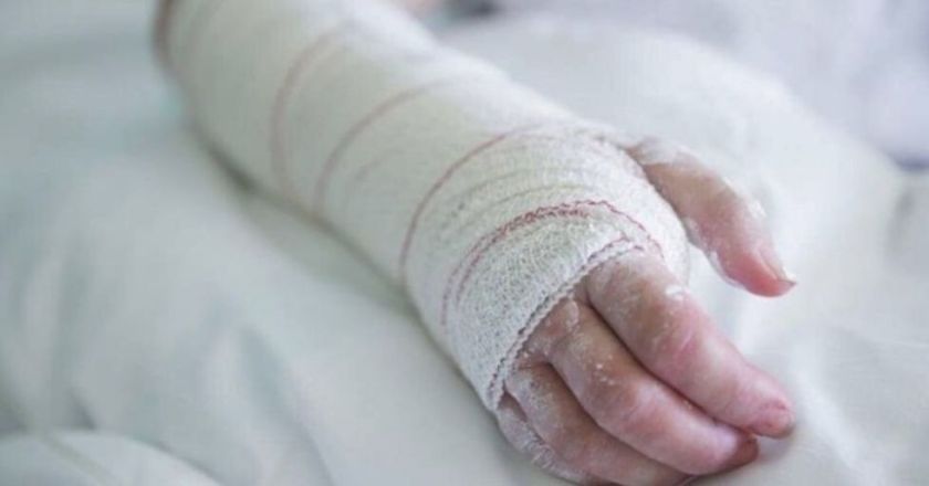Cochabamba: Hombre es imputado por tentativa de feminicidio tras quemar a su pareja con gasolina