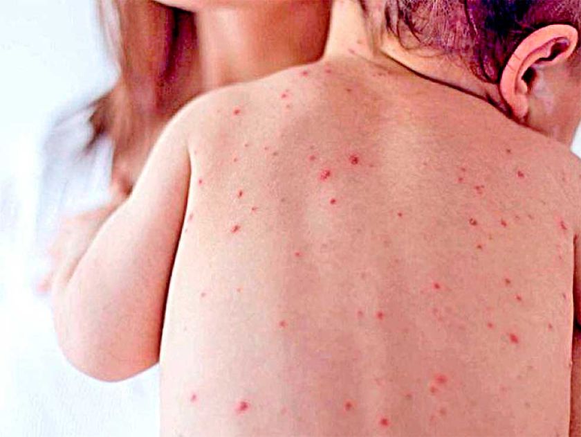 Sarampión: Suman 50 casos y Salud urge a la vacunación