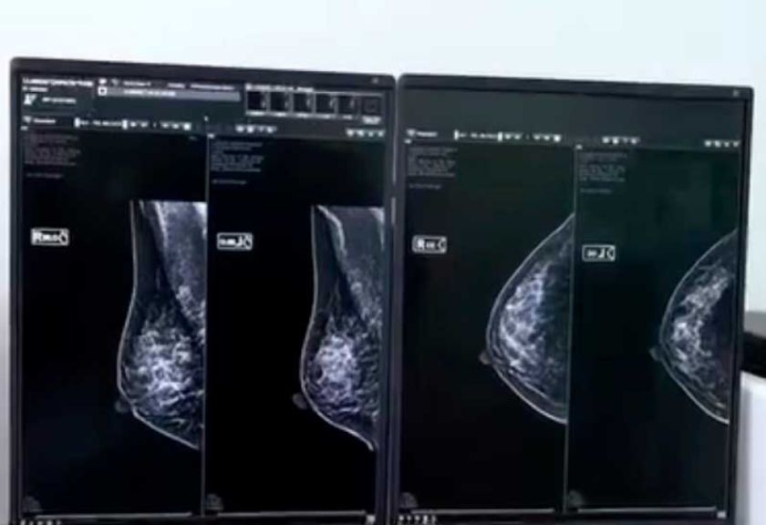 Bracamonte busca prevenir casos de cáncer de mama