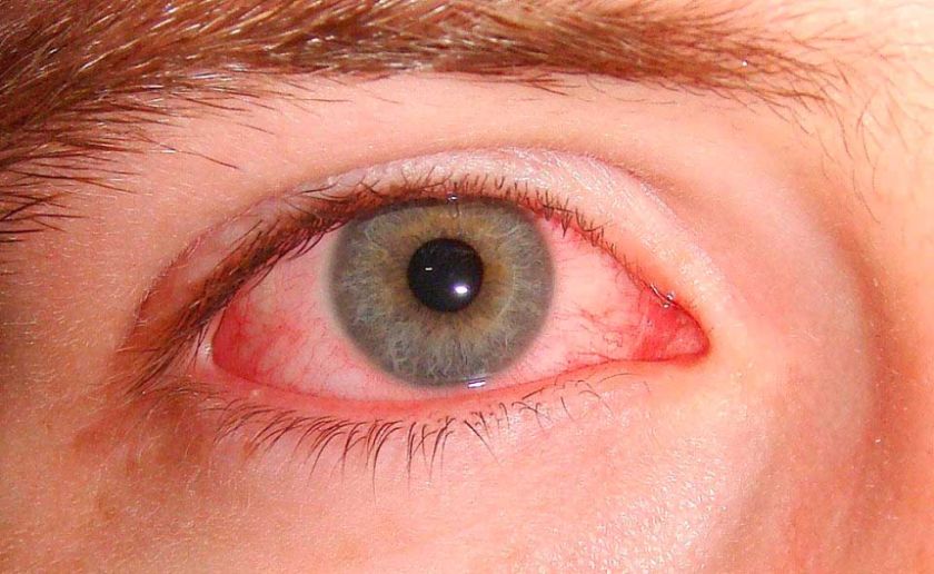Los vientos pueden provocar conjuntivitis en la población