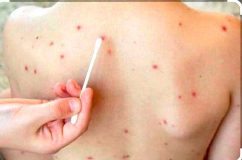 Sedes-Potosí se mantiene alerta por casos de varicela