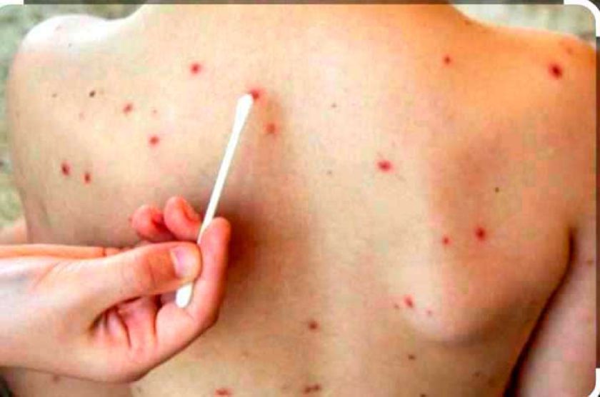 Varicela aumenta y enciende  alerta sanitaria en Potosí